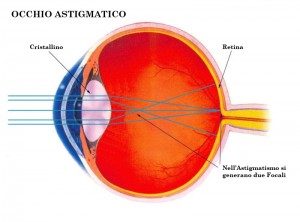 astigmatismo